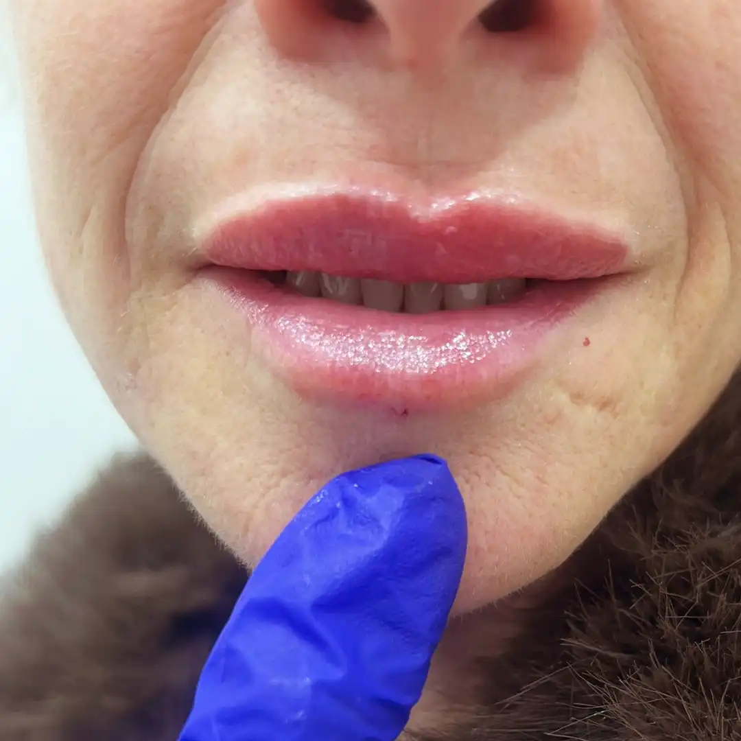 Lip Filler After
