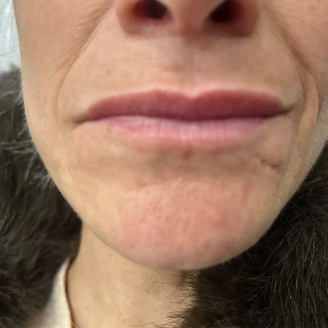 Lip Filler Before