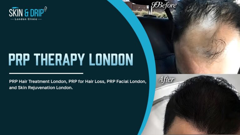 PRP Therapy London for Natural Skin Rejuvenation and Hair Restoration